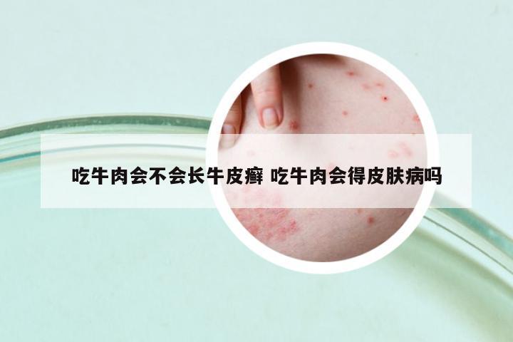 吃牛肉會不會長牛皮癬 吃牛肉會得皮膚病嗎