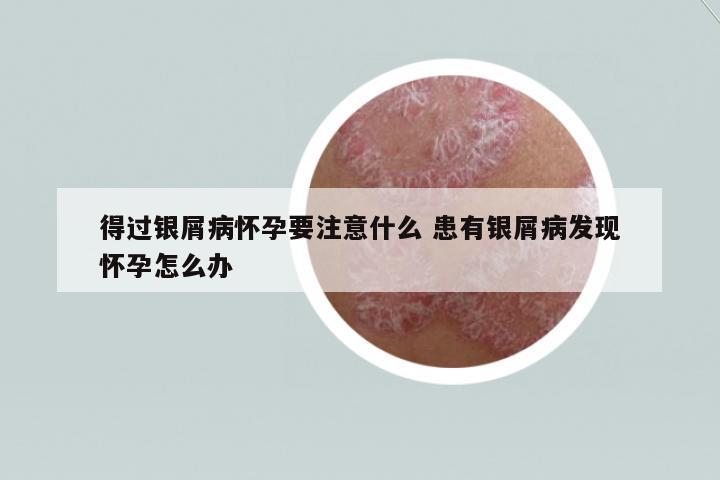 得過銀屑病懷孕要注意什么 患有銀屑病發(fā)現(xiàn)懷孕怎么辦