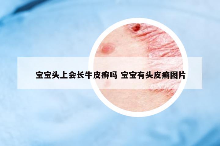 寶寶頭上會長牛皮癬嗎 寶寶有頭皮癬圖片