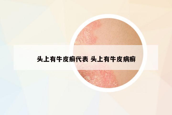 頭上有牛皮癬代表 頭上有牛皮病癬