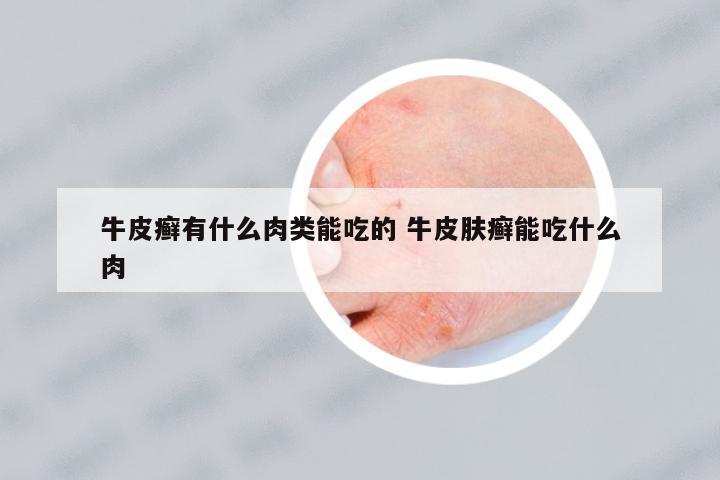 牛皮癬有什么肉類(lèi)能吃的 牛皮膚癬能吃什么肉