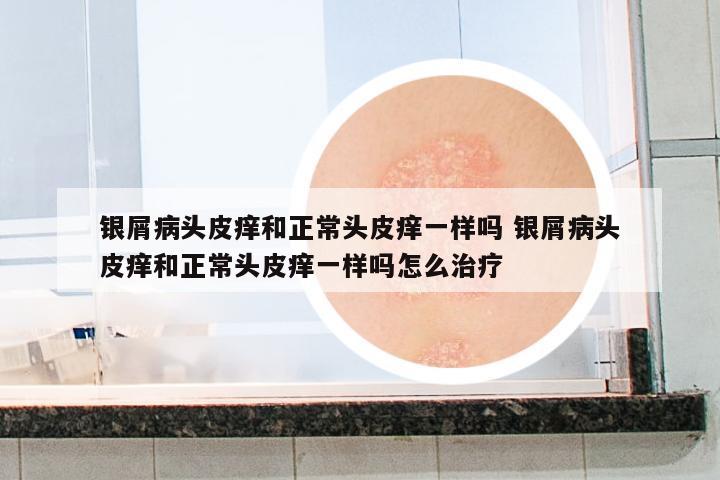 銀屑病頭皮癢和正常頭皮癢一樣嗎 銀屑病頭皮癢和正常頭皮癢一樣嗎怎么治療