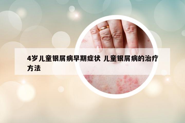 4歲兒童銀屑病早期癥狀 兒童銀屑病的治療方法