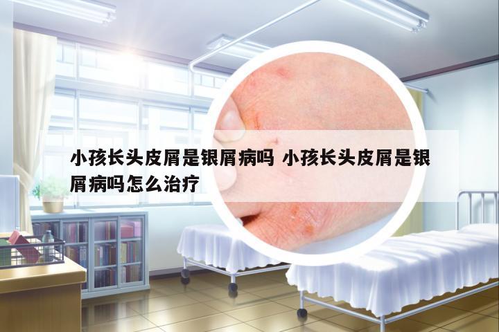 小孩長頭皮屑是銀屑病嗎 小孩長頭皮屑是銀屑病嗎怎么治療