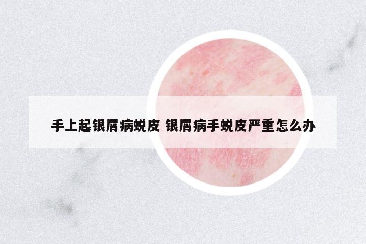 手上起銀屑病蛻皮 銀屑病手蛻皮嚴(yán)重怎么辦