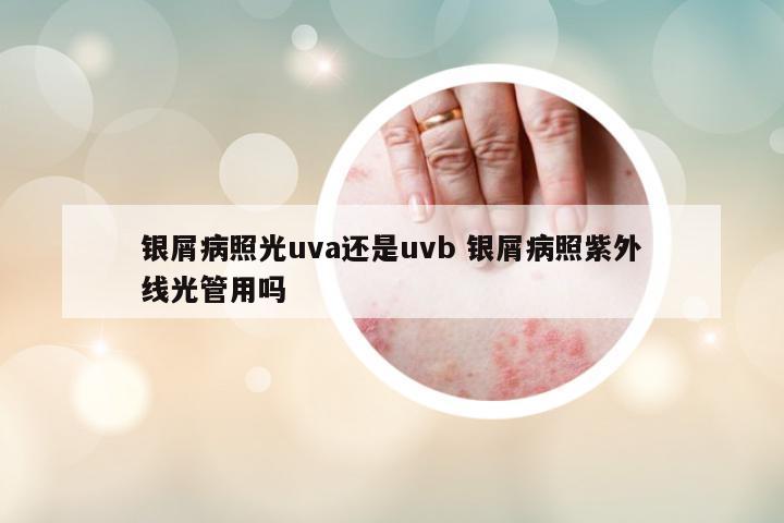銀屑病照光uva還是uvb 銀屑病照紫外線光管用嗎