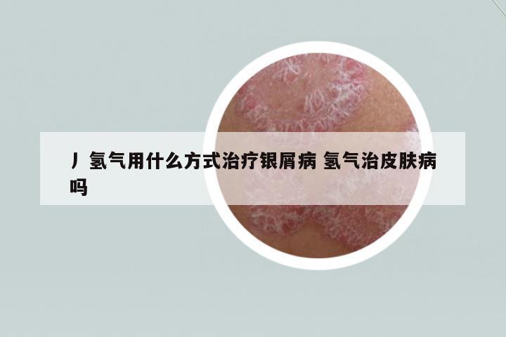 丿氫氣用什么方式治療銀屑病 氫氣治皮膚病嗎