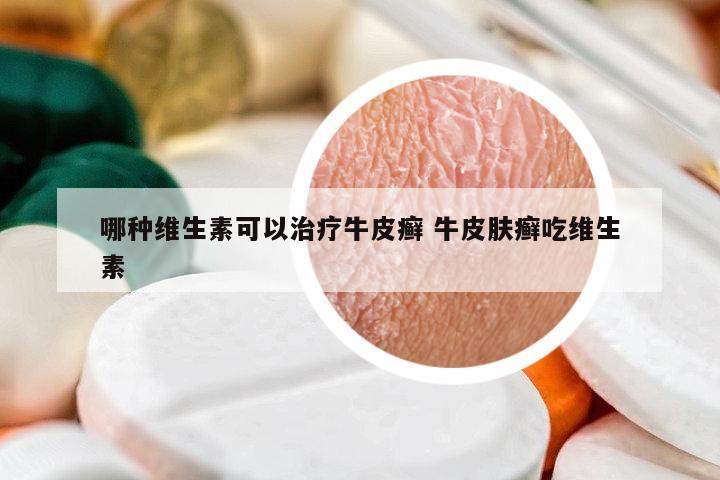 哪種維生素可以治療牛皮癬 牛皮膚癬吃維生素