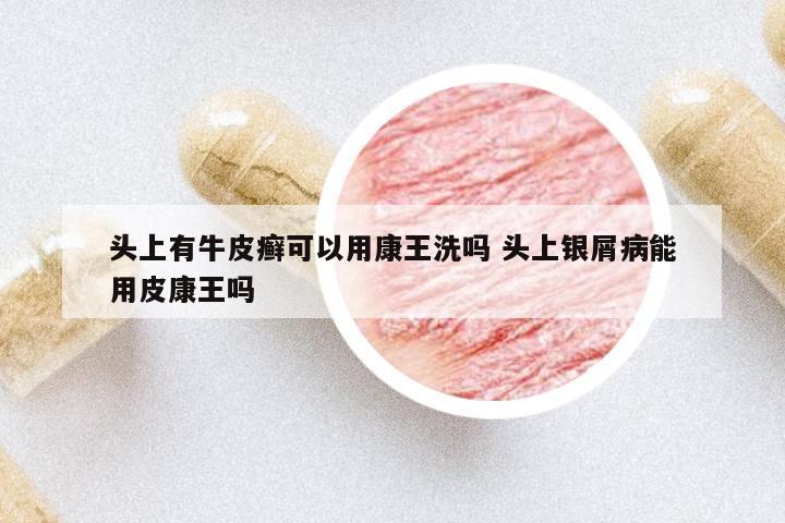 頭上有牛皮癬可以用康王洗嗎 頭上銀屑病能用皮康王嗎