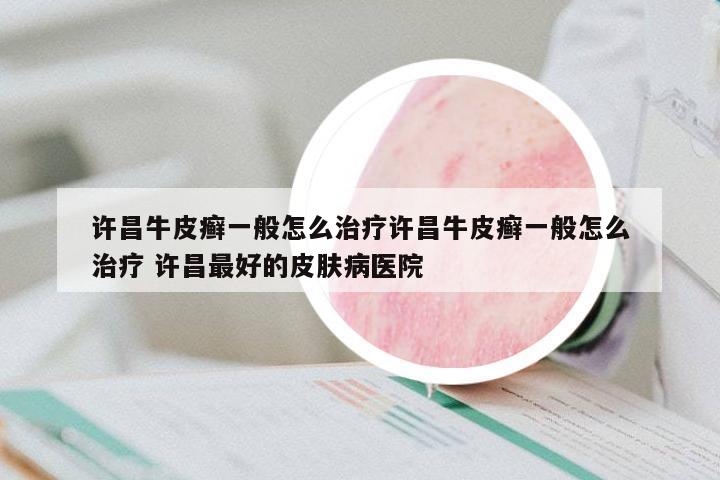 許昌牛皮癬一般怎么治療許昌牛皮癬一般怎么治療 許昌最好的皮膚病醫(yī)院