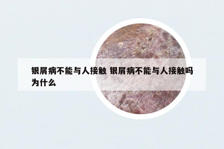 銀屑病不能與人接觸 銀屑病不能與人接觸嗎為什么
