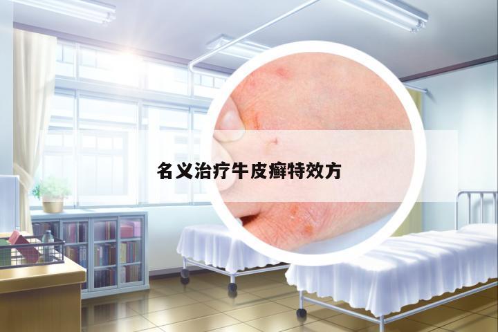 名義治療牛皮癬特效方