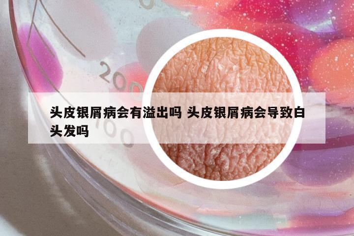 頭皮銀屑病會有溢出嗎 頭皮銀屑病會導(dǎo)致白頭發(fā)嗎