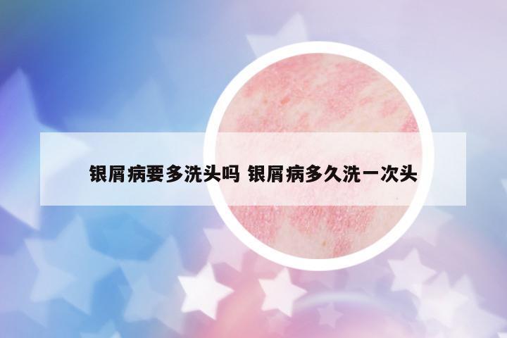 銀屑病要多洗頭嗎 銀屑病多久洗一次頭