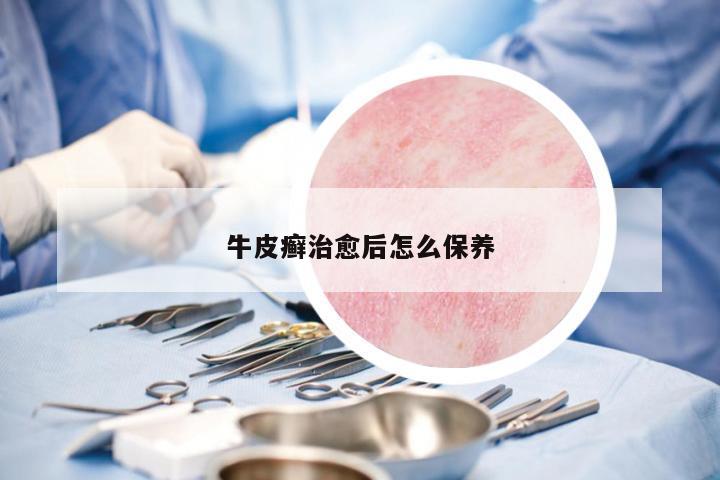 牛皮癬治愈后怎么保養(yǎng)