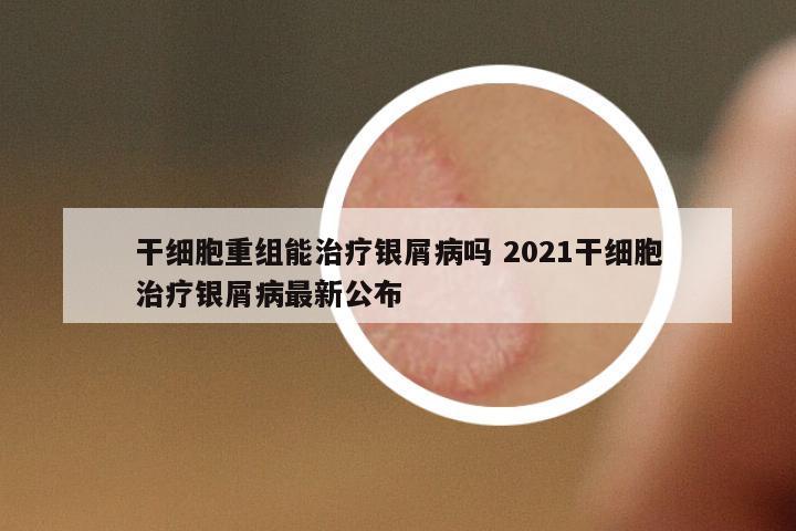 干細(xì)胞重組能治療銀屑病嗎 2021干細(xì)胞治療銀屑病最新公布
