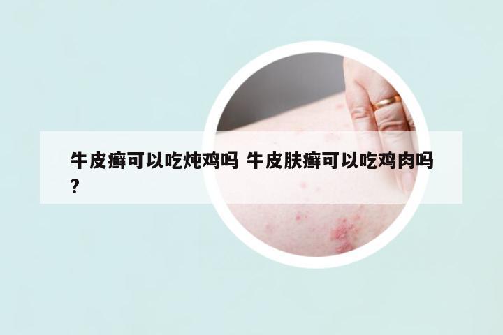 牛皮癬可以吃燉雞嗎 牛皮膚癬可以吃雞肉嗎?