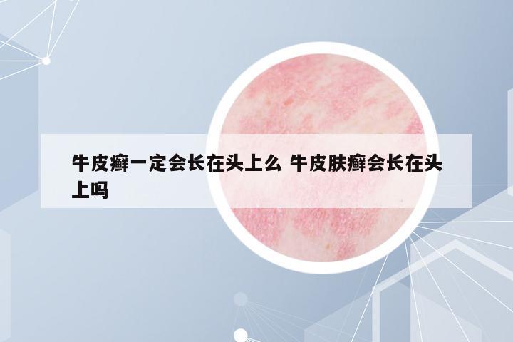 牛皮癬一定會長在頭上么 牛皮膚癬會長在頭上嗎