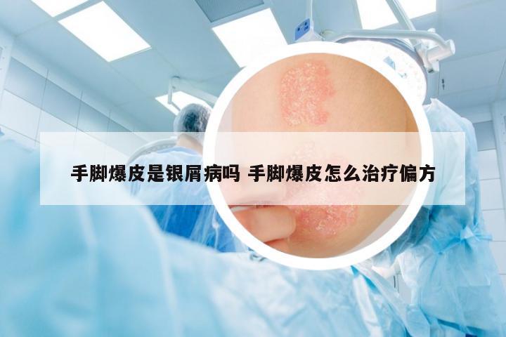 手腳爆皮是銀屑病嗎 手腳爆皮怎么治療偏方