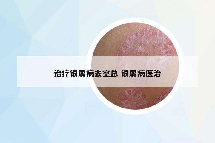 治療銀屑病去空總 銀屑病醫(yī)治