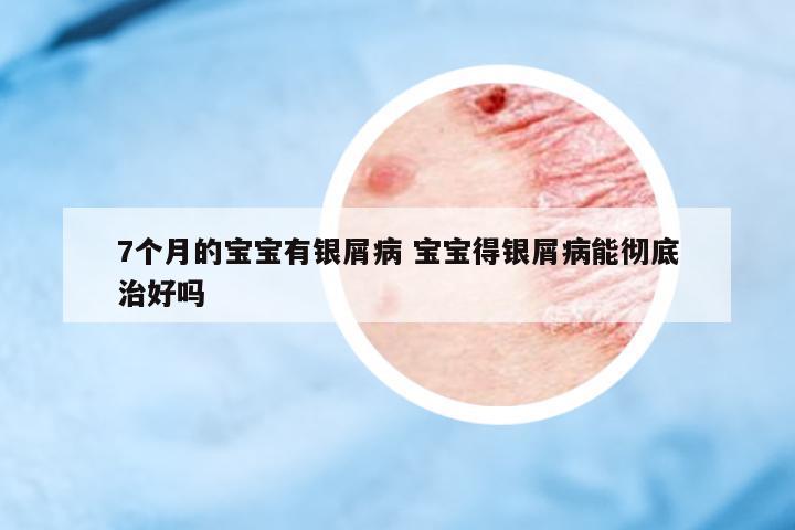 7個月的寶寶有銀屑病 寶寶得銀屑病能徹底治好嗎