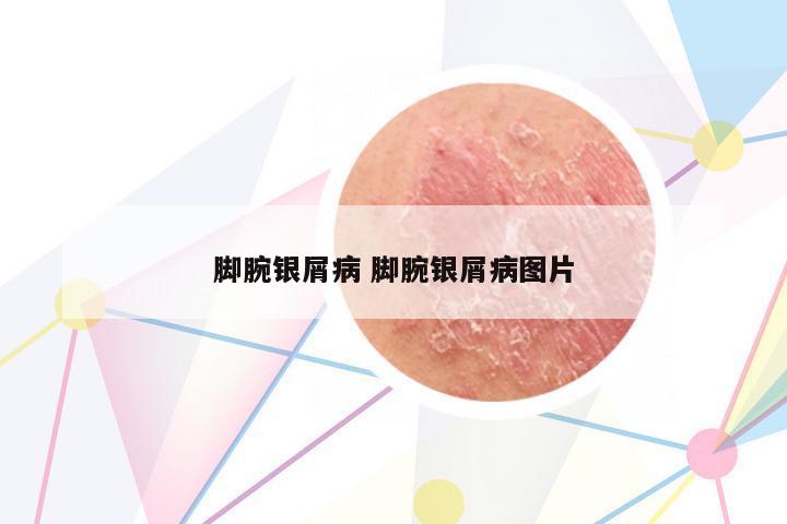 腳腕銀屑病 腳腕銀屑病圖片