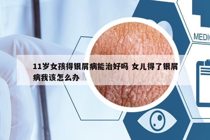 11歲女孩得銀屑病能治好嗎 女兒得了銀屑病我該怎么辦