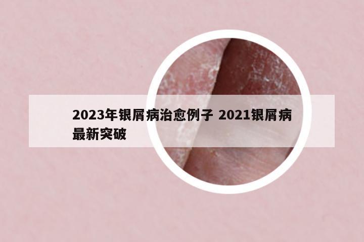 2023年銀屑病治愈例子 2021銀屑病最新突破