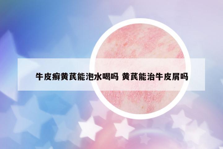 牛皮癬黃芪能泡水喝嗎 黃芪能治牛皮屑嗎