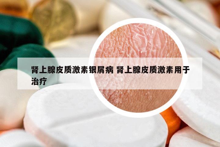 腎上腺皮質(zhì)激素銀屑病 腎上腺皮質(zhì)激素用于治療
