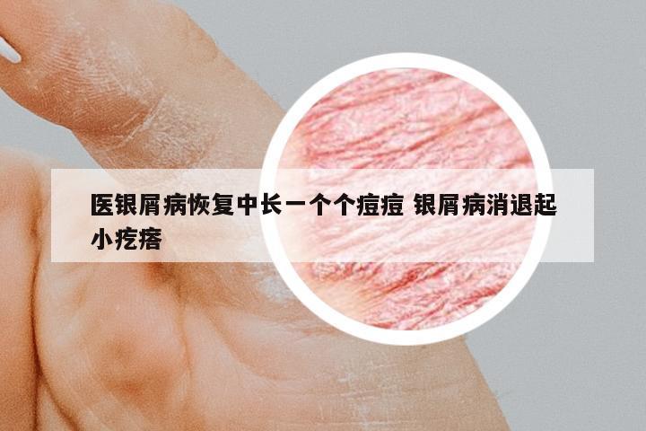 醫(yī)銀屑病恢復(fù)中長(zhǎng)一個(gè)個(gè)痘痘 銀屑病消退起小疙瘩