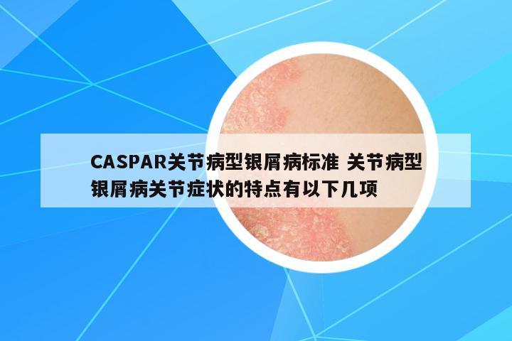 CASPAR關(guān)節(jié)病型銀屑病標(biāo)準(zhǔn) 關(guān)節(jié)病型銀屑病關(guān)節(jié)癥狀的特點有以下幾項