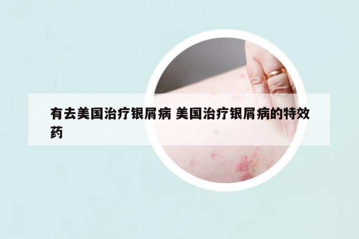 有去美國治療銀屑病 美國治療銀屑病的特效藥