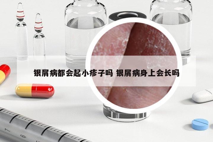 銀屑病都會(huì)起小疹子嗎 銀屑病身上會(huì)長(zhǎng)嗎