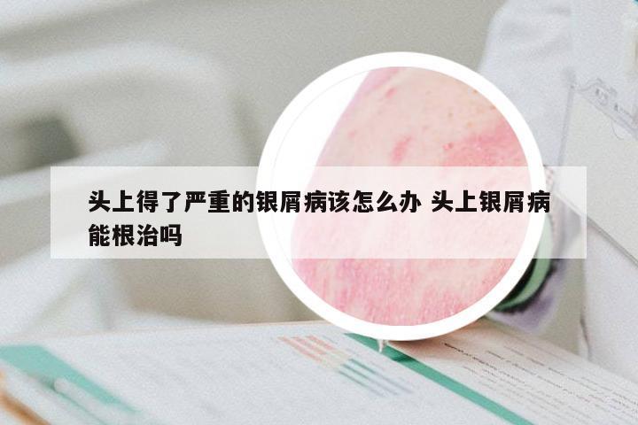 頭上得了嚴重的銀屑病該怎么辦 頭上銀屑病能根治嗎