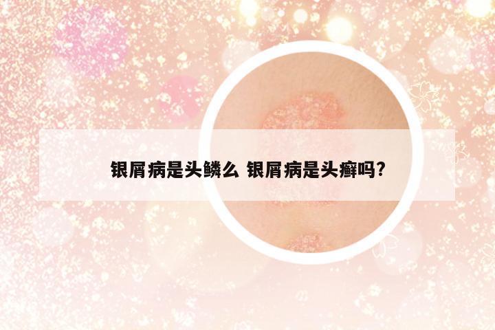 銀屑病是頭鱗么 銀屑病是頭癬嗎?