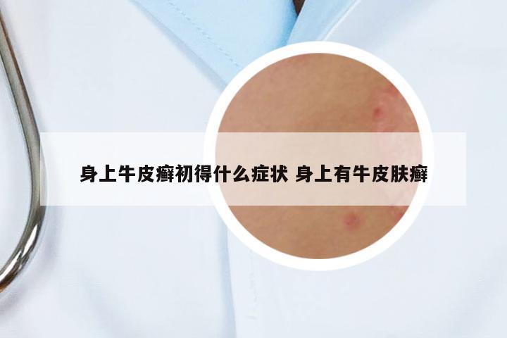 身上牛皮癬初得什么癥狀 身上有牛皮膚癬