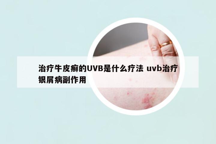 治療牛皮癬的UVB是什么療法 uvb治療銀屑病副作用
