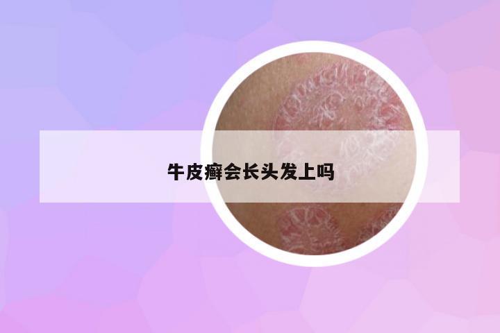 牛皮癬會(huì)長(zhǎng)頭發(fā)上嗎