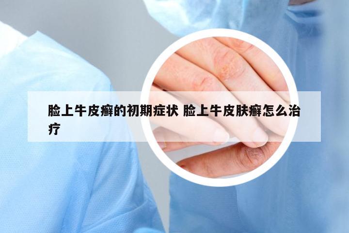 臉上牛皮癬的初期癥狀 臉上牛皮膚癬怎么治療