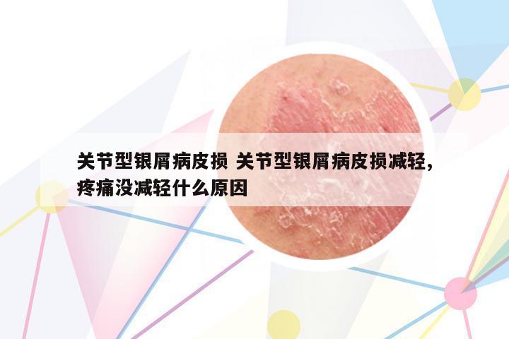 關(guān)節(jié)型銀屑病皮損 關(guān)節(jié)型銀屑病皮損減輕,疼痛沒減輕什么原因