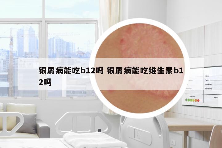 銀屑病能吃b12嗎 銀屑病能吃維生素b12嗎