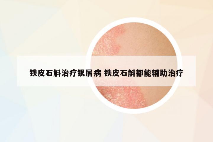 鐵皮石斛治療銀屑病 鐵皮石斛都能輔助治療