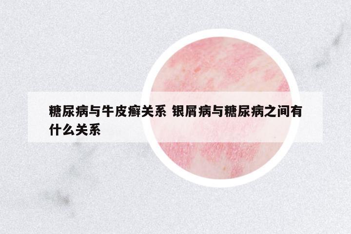 糖尿病與牛皮癬關(guān)系 銀屑病與糖尿病之間有什么關(guān)系