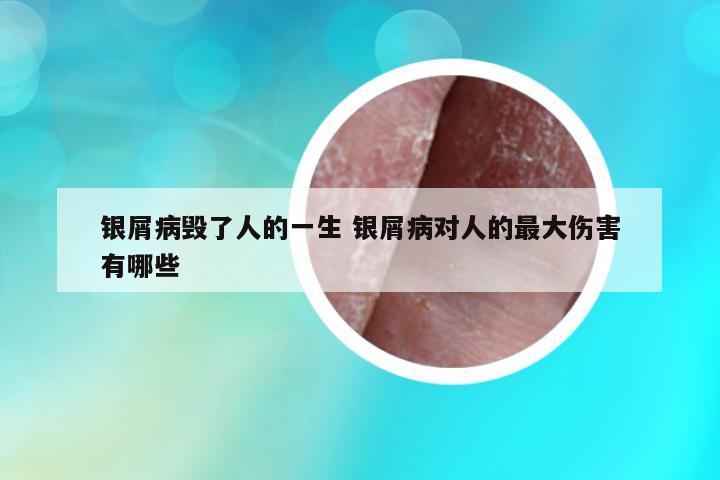 銀屑病毀了人的一生 銀屑病對(duì)人的最大傷害有哪些