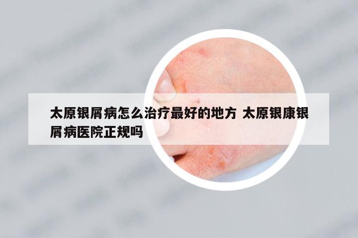 太原銀屑病怎么治療最好的地方 太原銀康銀屑病醫(yī)院正規(guī)嗎