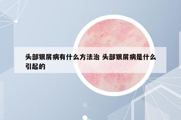 頭部銀屑病有什么方法治 頭部銀屑病是什么引起的