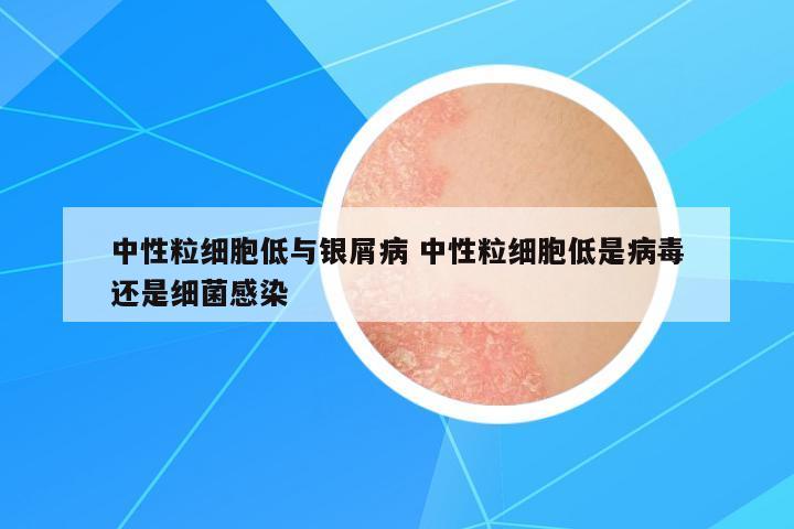 中性粒細(xì)胞低與銀屑病 中性粒細(xì)胞低是病毒還是細(xì)菌感染