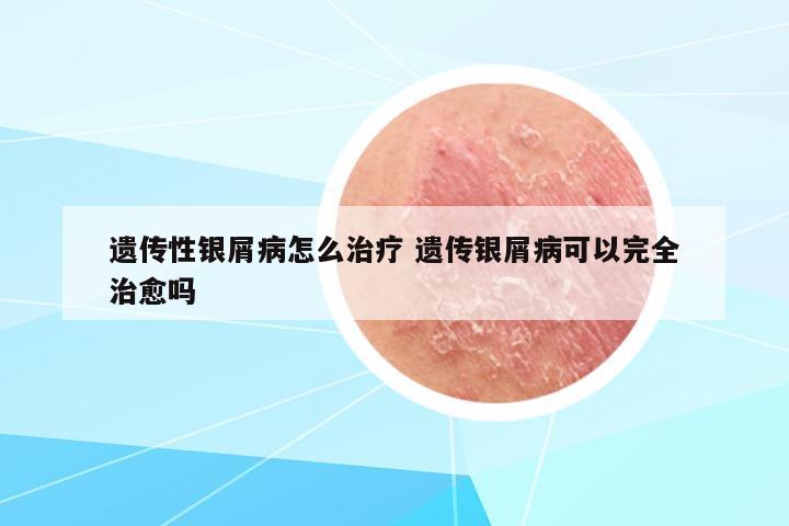遺傳性銀屑病怎么治療 遺傳銀屑病可以完全治愈嗎