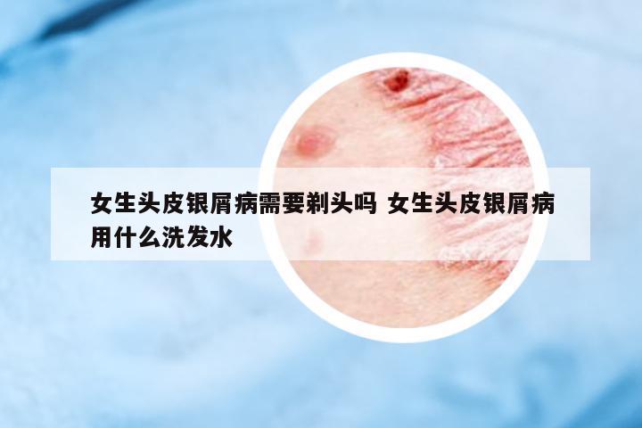 女生頭皮銀屑病需要剃頭嗎 女生頭皮銀屑病用什么洗發(fā)水